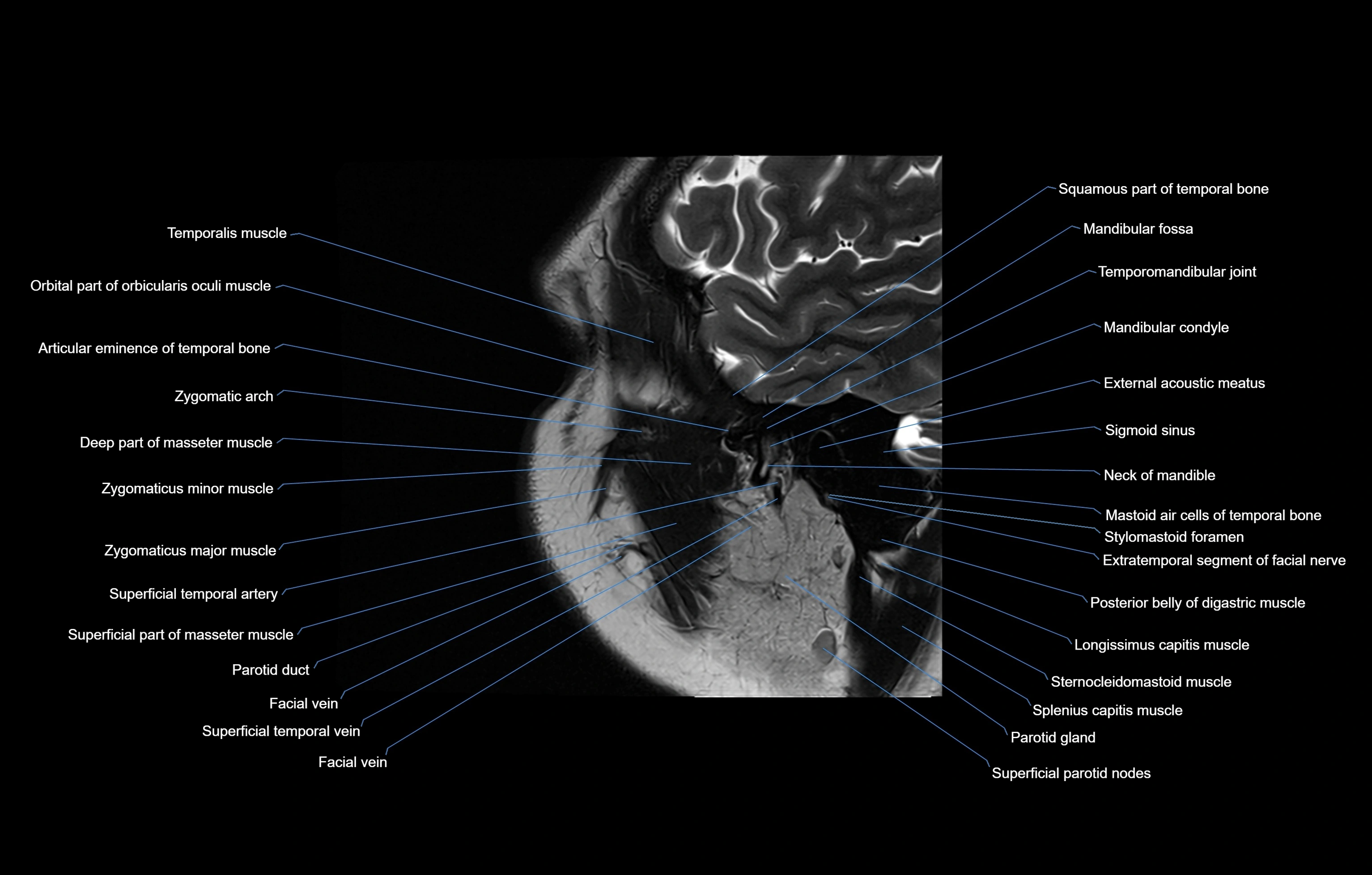paranasal sinuses(PNS) MRI coronal  cross sectional anatomy 3T radiology  image-img-00001-00021.webp
